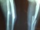 Co to jest osteoporoza? szpital ortopedyczny Warszawa